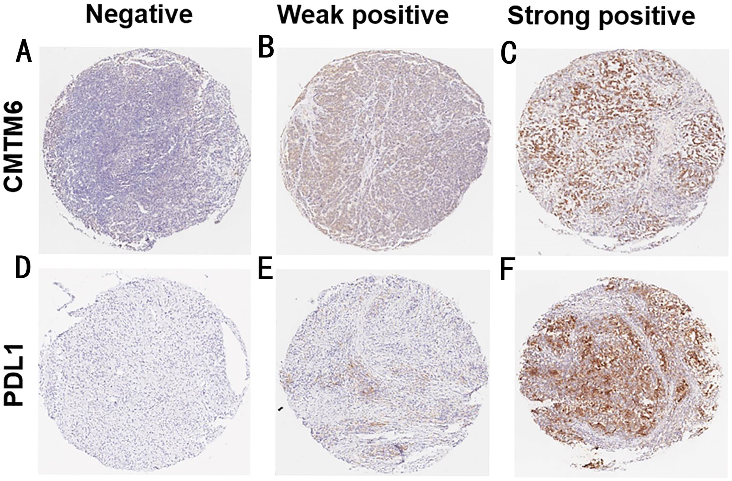 CMTM6 Significantly Relates To PD L1 And Predicts The Prognosis Of