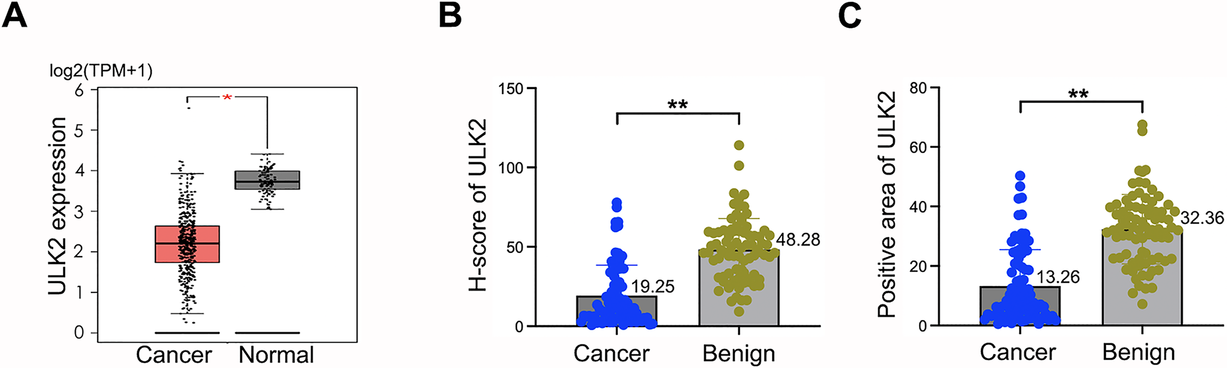 Ulk Suppresses Ovarian Cancer Cell Migration And Invasion By Elevating