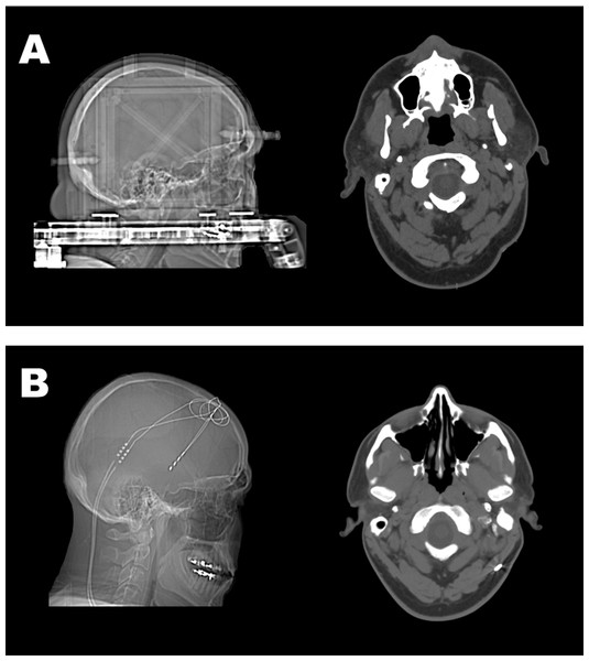 Sagittal and transverse computed tomography (CT) images of the brain and skull of MA.