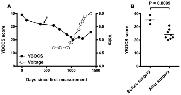 Yale Brown Obsessive Compulsive Scale (YBOCS) scores were measured for MA over a three year and seven months period of time.