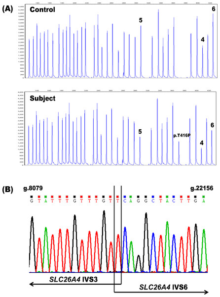 Identification of the heterozygous SLC26A4 deletion g.8091T-22145Cdel in subject PDS41.