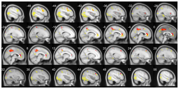 TNN activations (No Task > Task) in hearing (yellow) and Deaf (red) participants.