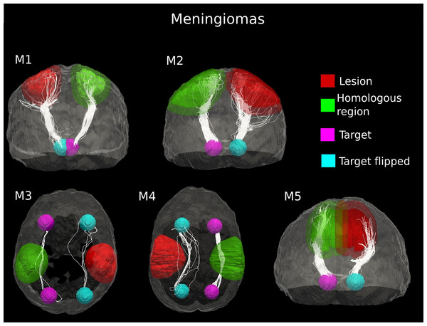 Comparative tractography study between the two hemispheres in the five cases of meningioma.