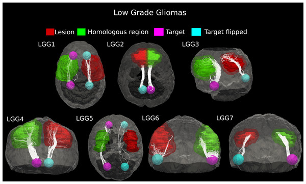 Comparative tractography study between the two hemispheres in the seven cases of low-grade glioma.