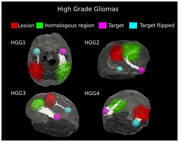 Comparative tractography study between the two hemispheres in the four cases of high-grade gliomas.