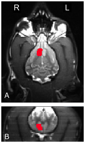The right caudate seed, anatomically defined, used for participant Kady, in the transverse (A) and coronal (B) planes.