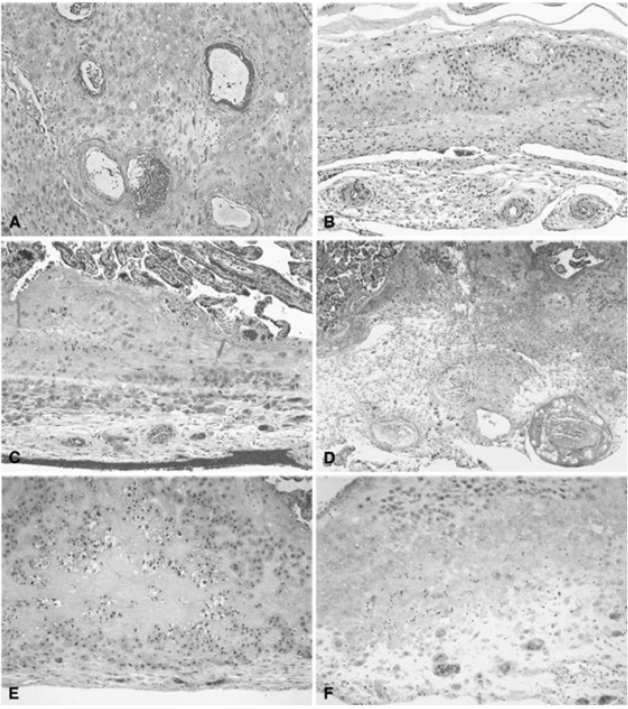 Placental vascular pathology and increased thrombin generation as ...