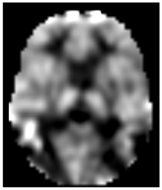 ASL blood flow image of one subject’s 2-back run before levodopa on the placebo day.