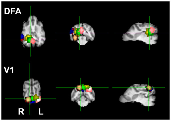 ROI locations for the dog face area (DFA) and primary visual cortex (V1).