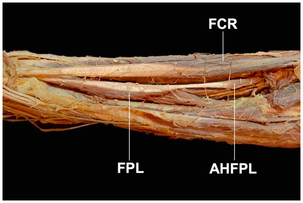 The accessory head of the flexor pollicis longus muscle (AHFPL) originating from the flexoe digitoum profundus.