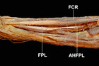 The prevalence and anatomical characteristics of the accessory head of ...