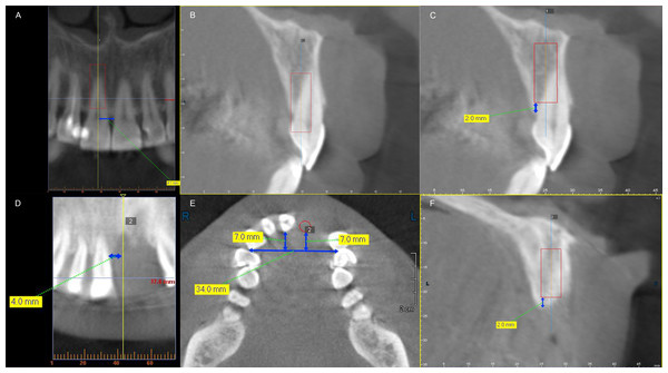 Three-dimensional location of virtual implant in dentate patients (A–C) and partially edentulous patients (D–F).