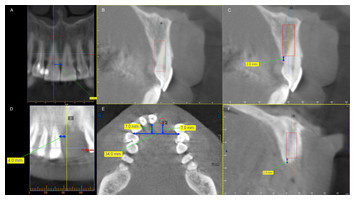 Relationship of central incisor implant placement to the ridge ...