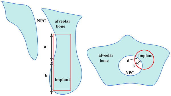 Description of nasopalatine canal (NPC) perforation in both sagittal slice and axial slice.