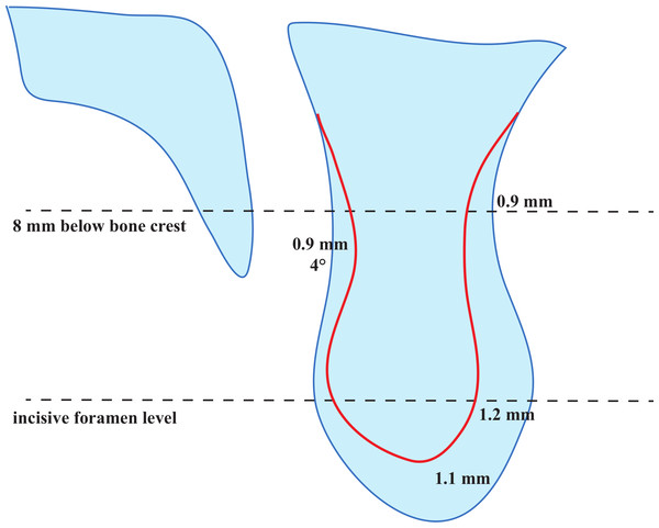 Comparison of ridge configuration anterior to the nasopalatine canal (NPC) between dentate and partially edentulous patients.