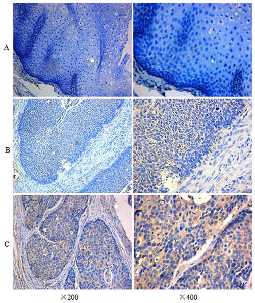 Immunohistochemistry assay of IFITM3 in ESCC tissue and ANM.