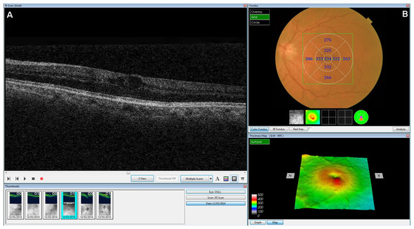 Screenshot of the retinal map analysis.