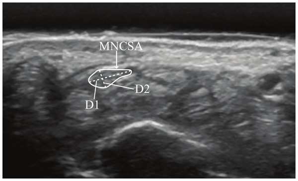 Quantifying median nerve cross-sectional area (MNCSA), median nerve longitudinal diameter (D1), and median nerve vertical diameter (D2) at the proximal carpal tunnel.