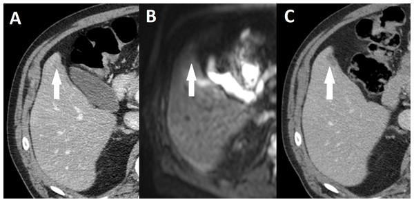 Missed liver metastasis on CT and diffusion weighted MR.