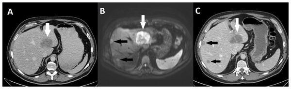 Missed liver metastasis segment 7 & 8 on CT and diffusion weighted MR.