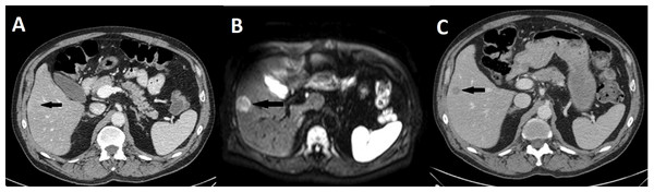 Missed metastasis on initial CT and diffusion weighted MR.