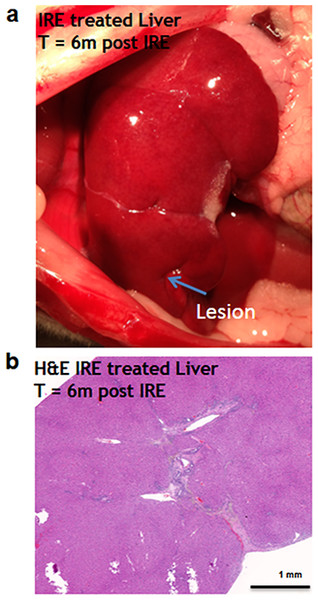 Liver regeneration 6 months after IRE ablation.