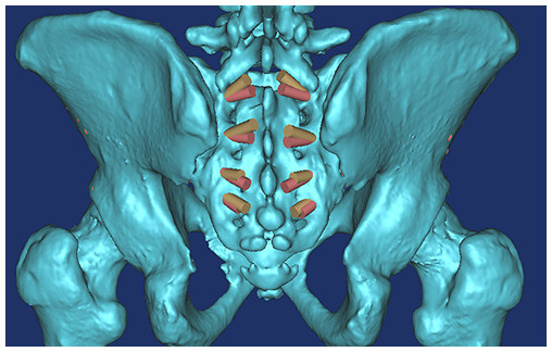 All of the S1AI-S4AI screw trajectories were simulated on 3D digital image; the ideal entry point was at the inner fovea of the transverse process of the sacrum.