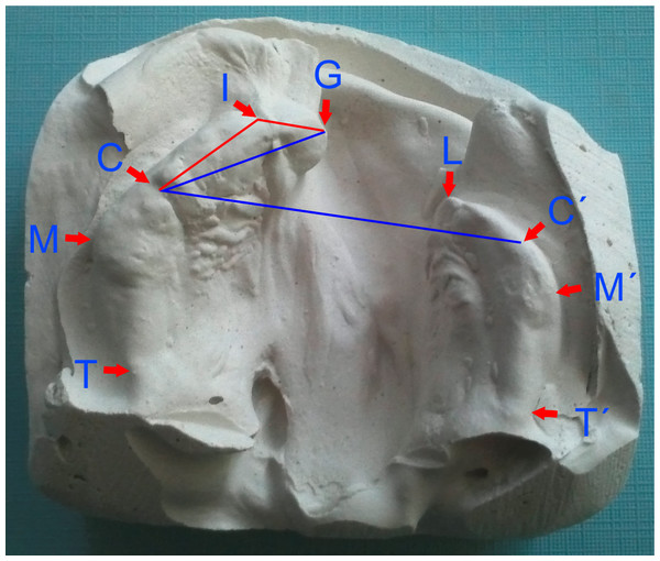 Identification of individual landmarks used for linear and angular (GIC-red, GC-CC′-blue) measurements.