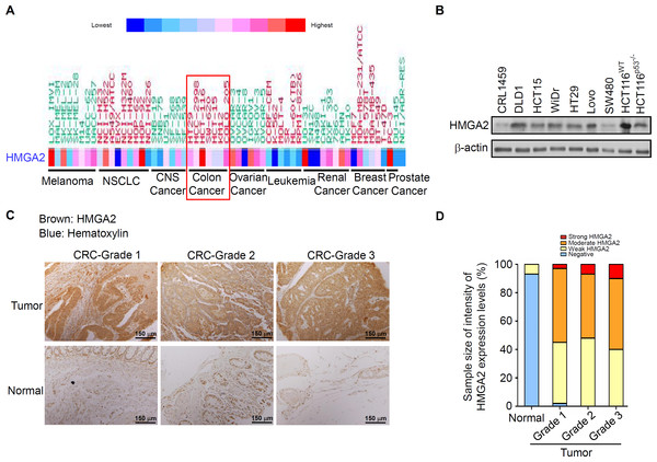 HMGA2 was overexpressed in Colorectal Cancer (CRC) cell lines and tumors.