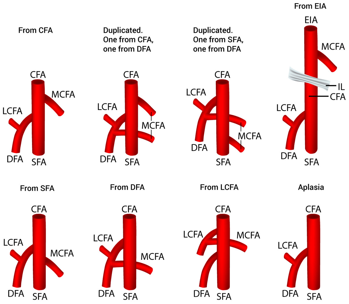 The Origin Of The Medial Circumflex Femoral Artery A Meta analysis And 