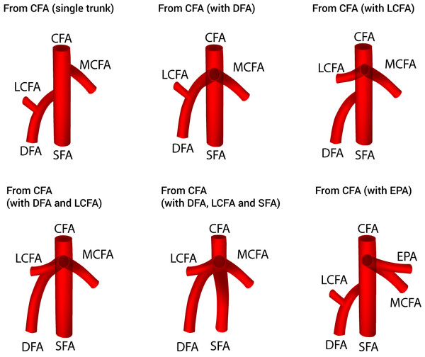 Sub-variants of the medial circumflex femoral artery origins from the common femoral artery.