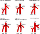 The Origin Of The Medial Circumflex Femoral Artery: A Meta-analysis And 