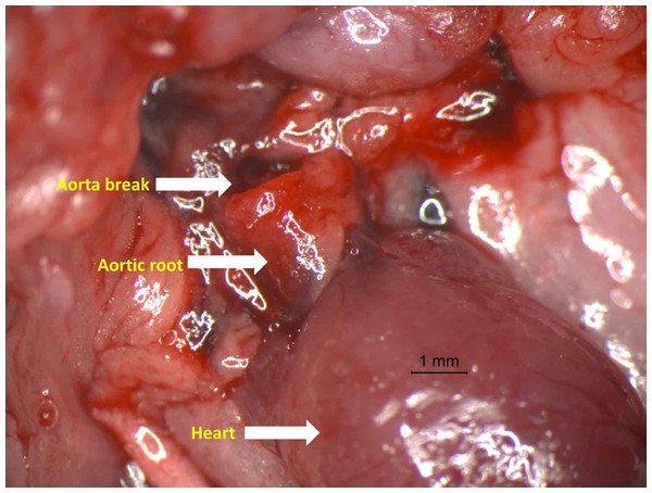 Photograph of aorta dissection showing the severe rupture just distal to aortic root.