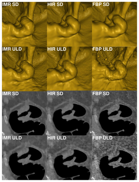 Comparison of image quality of a rectosigmoid tumor in virtual endoscopic view and thin 0.9 mm sections in a colonic window (900/100 HU) demonstrates markedly reduced image quality in FBP-ULD.