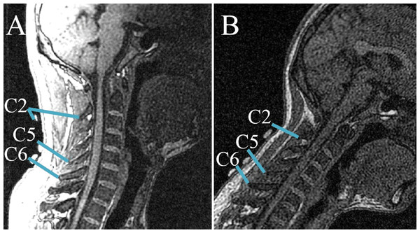 Relative positions of skin markers and corresponding spinous processes/vertebral landmarks in the sagittal plane at two postures: (A) NP; (B) second flexion position.