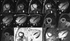 A retrospective study: cardiac MRI of fulminant myocarditis in children ...