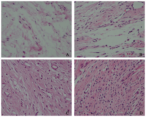 The effect of HCPT on fibroblast in epidural scar tissue in rats.