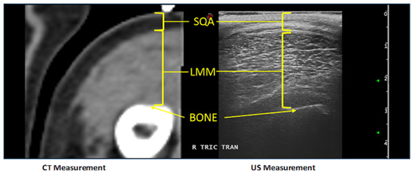 Example of the comparison between US and CT measurements for a canine patient’s cubital extensor muscle group.