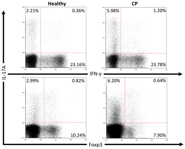 Percentage of IL-17A, IFN-γ and Foxp3 expressing CD4+ T cells in peripheral blood from healthy volunteers and CP patients.