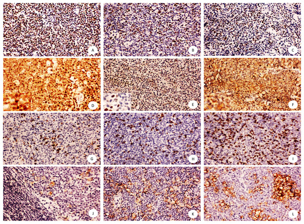Immunohistochemical staining of mantle cell lymphoma using anti-SOX11, Ki67, p53, C-MYC,CD8, PD-L1.