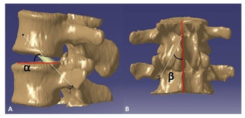 Improving the trajectory of transpedicular transdiscal lumbar screw ...