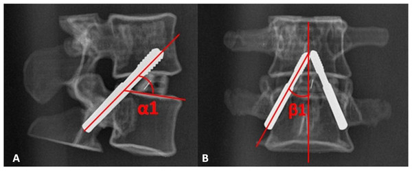 The radiographic lateral and anteroposterior (AP) films of the 3D printed lumbar model were obtained after the TPTD screw was introduced.