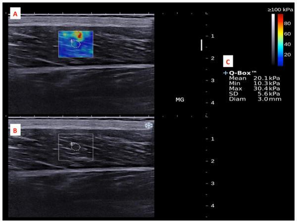 A shear wave elastogram (A) and the corresponding grey-scale ultra-sonogram (B) in the longitudinal axis of a medial gastrocnemius muscle (MG) on the dominant leg of a subject after a heel drop exercise.
