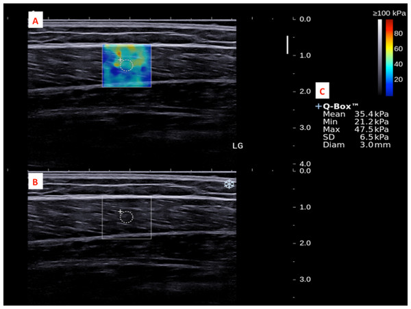 A shear wave elastogram (A) and the corresponding grey-scale ultra-sonogram (B) in the longitudinal axis of a lateral gastrocnemius muscle (LG) on the dominant leg of a subject after a heel drop exercise.