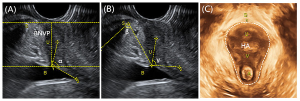 Transperineal ultrasound measurement of pregnant women.