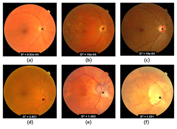 Contrast based circular approximation for accurate and robust optic ...