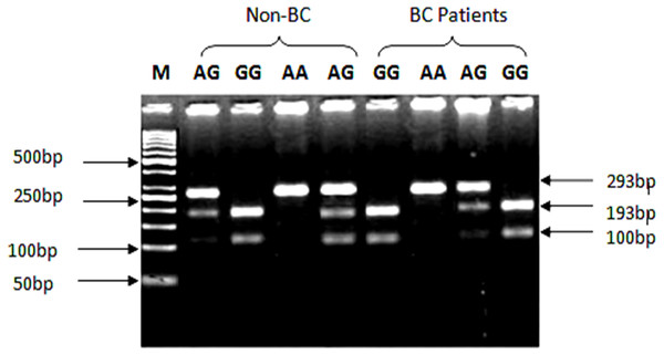Genotypic variations of SNP (rs1801157; G/A) of CXCL12 gene in cases and control groups.