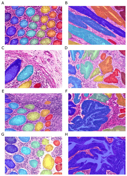 Samples of benign (A, C, E, G) and malignant (B, D, F, H) colorectal cancer sections in the Warwick-QU dataset.