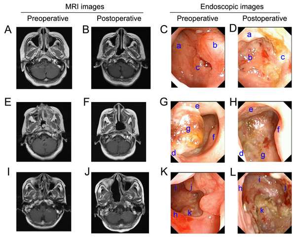 Pre- and post-operative MRI and high-definition endoscopic images.