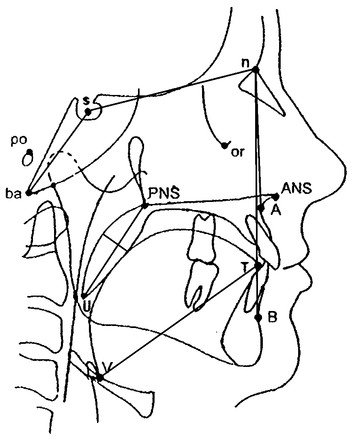 A retrospective study: does upper airway morphology differ between non ...